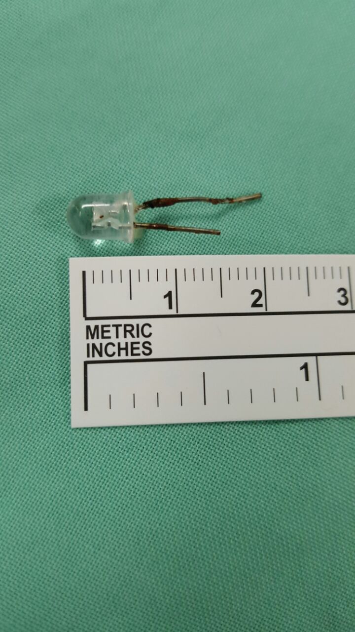 הנורה באורך 2 סנטימטר שנשלפה מראותיו של התינוק